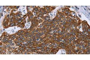 Immunohistochemistry of paraffin-embedded Human cervical cancer using GRPR Polyclonal Antibody at dilution of 1:40 (GRPR 抗体)