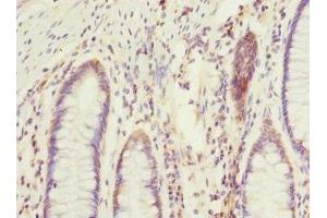 Immunohistochemistry of paraffin-embedded human colon cancer using ABIN7172903 at dilution of 1:100 (EIF2B2 抗体  (AA 1-351))