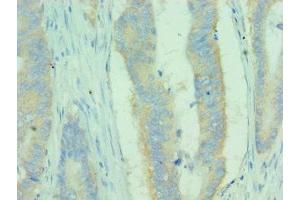 Immunohistochemistry of paraffin-embedded human colon cancer using ABIN7159681 at dilution of 1:100 (MICA 抗体  (AA 24-307))