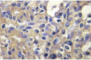 Immunohistochemistry (IHC) analyzes of MELK antibody in paraffin-embedded human liver carcinoma tissue. (MELK 抗体)