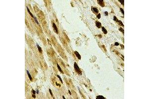 Immunohistochemical analysis of PSMA2 staining in human esophageal cancer formalin fixed paraffin embedded tissue section. (PSMA2 抗体)