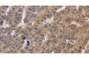 Immunohistochemistry of paraffin-embedded Human liver cancer using SDCCAG3 Polyclonal Antibody at dilution of 1:30 (SDCCAG3 抗体)