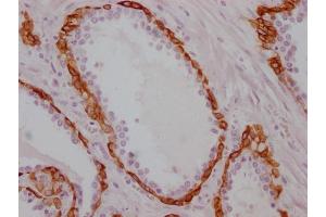 IHC image of ABIN7180960 diluted at 1:100 and staining in paraffin-embedded human prostate cancer performed on a Leica BondTM system. (KRT17 抗体)
