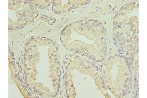 Immunohistochemistry of paraffin-embedded human prostate cancer using ABIN7153936 at dilution of 1:100 (GID8/C20orf11 抗体  (AA 1-228))