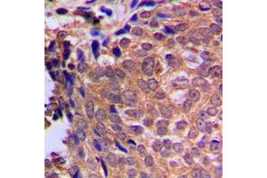 Immunohistochemical analysis of Cofilin staining in human breast cancer formalin fixed paraffin embedded tissue section. (Cofilin 抗体  (N-Term))