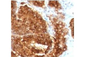 IHC staining of human prostate carcinoma with TAG-72 antibody (TAG-72 抗体)