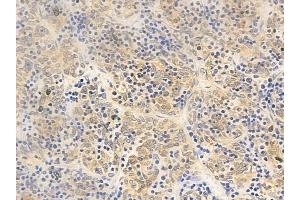 ABIN6257046 and ABIN6275707 at 1/100 staining human thymoma by IHC-P.