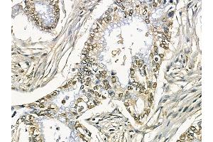 ZIP7 Mouse Monoclonal Antibody at 1/100 staining human pancreatic cancer by IHC-P. (SLC39A7 抗体)