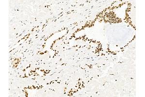 ABIN7094820 and ABIN7098871 at 1/100 staining Human liver cancer by IHC-P.