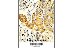 Formalin-fixed and paraffin-embedded human Lung carcinoma reacted with RARS2 Antibody , which was peroxidase-conjugated to the secondary antibody, followed by DAB staining. (RARS2 抗体  (C-Term))