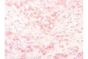 Formalin-fixed, paraffin-embedded human Melanoma stained with TYRP1 Rabbit Polyclonal Antibody using AEC Chromogen (red). (Tyrosinase-Related Protein 1 抗体)