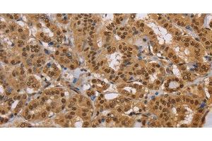 Immunohistochemistry of paraffin-embedded Human thyroid cancer using CEL Polyclonal Antibody at dilution of 1:40 (Cholesterol Esterase 抗体)