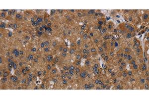 Immunohistochemistry of paraffin-embedded Human liver cancer using NDUFS8 Polyclonal Antibody at dilution of 1:50