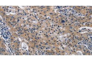 Immunohistochemistry of paraffin-embedded Human gastric cancer using CD160 Polyclonal Antibody at dilution of 1:30 (CD160 抗体)
