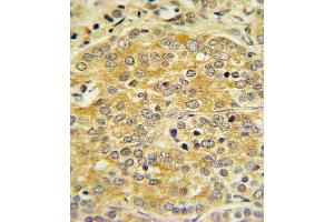 OL1 Antibody (C-term) 7361b IHC analysis in formalin fixed and paraffin embedded human Prostate carcinoma followed by peroxidase conjugation of the secondary antibody and DAB staining. (APOL1 抗体  (C-Term))