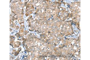 Immunohistochemistry of Human breast cancer using SESN2 Polyclonal Antibody at dilution of 1:30 (Sestrin 2 抗体)