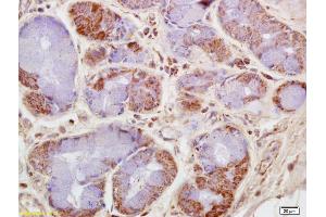 Formalin-fixed and paraffin embedded human lung carcinoma labeled with Rabbit Anti CKMT/Creatine kinase MT Polyclonal Antibody, Unconjugated (ABIN717536) at 1:200 followed by conjugation to the secondary antibody and DAB staining (CKMT1B 抗体  (AA 115-220))