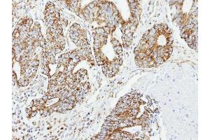 IHC-P Image Immunohistochemical analysis of paraffin-embedded OVCA xenograft, using DCI, antibody at 1:100 dilution. (DCI 抗体)