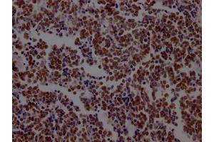 IHC image of ABIN7127590 diluted at 1:100 and staining in paraffin-embedded human lung cancer performed on a Leica BondTM system. (Recombinant LSD1 抗体)