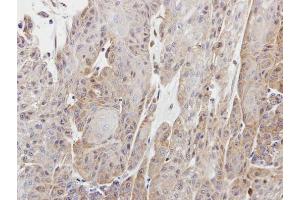 IHC-P Image Immunohistochemical analysis of paraffin-embedded Cal27 xenograft, using Copine I, antibody at 1:100 dilution. (CPNE1 抗体)