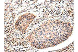 The image on the left is immunohistochemistry of paraffin-embedded Human esophagus cancer tissue using ABIN7191260(Lambda Light chain Antibody) at dilution 1/20, on the right is treated with synthetic peptide. (IGLV1-51 抗体)