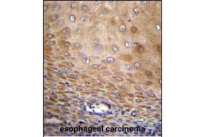 TMEM43 Antibody (Center) (ABIN656549 and ABIN2845811) immunohistochemistry analysis in formalin fixed and paraffin embedded human esophageal carcinoma followed by peroxidase conjugation of the secondary antibody and DAB staining. (TMEM43 抗体  (AA 195-223))