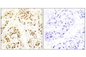 Immunohistochemistry analysis of paraffin-embedded human breast carcinoma tissue using FEN1 antibody. (FEN1 抗体  (Internal Region))