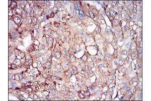 Immunohistochemical analysis of paraffin-embedded liver cancer tissues using FTL mouse mAb with DAB staining. (FTL 抗体  (AA 1-157))