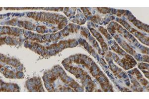 ABIN6267171 at 1/100 staining Human thyroid cancer tissue by IHC-P.