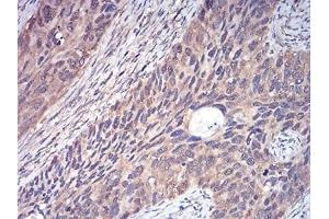 Immunohistochemical analysis of paraffin-embedded human cervical cancer tissues using YWHAB mouse mAb with DAB staining. (YWHAB 抗体  (AA 1-246))