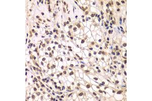Immunohistochemistry of paraffin-embedded human kidney cancer using SMARCC1 antibody. (SMARCC1 抗体  (AA 80-320))