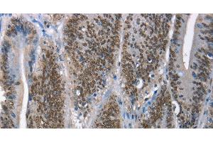 Immunohistochemistry of paraffin-embedded Human colon cancer tissue using GNRH1 Polyclonal Antibody at dilution 1:65 (GNRH1 抗体)