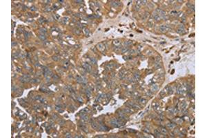 The image on the left is immunohistochemistry of paraffin-embedded Human ovarian cancer tissue using ABIN7191695(NPR2 Antibody) at dilution 1/45, on the right is treated with synthetic peptide. (NPR2 抗体)