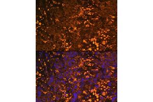 Immunofluorescence analysis of Human liver cancer using UGT1 antibody (ABIN6132769, ABIN6149895, ABIN6149896 and ABIN6221779) at dilution of 1:100. (UGT1A1 抗体  (AA 1-200))