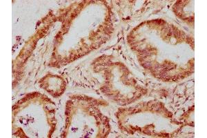 IHC image of ABIN7175822 diluted at 1:300 and staining in paraffin-embedded human colon cancer performed on a Leica BondTM system. (WAPAL 抗体  (AA 1037-1190))