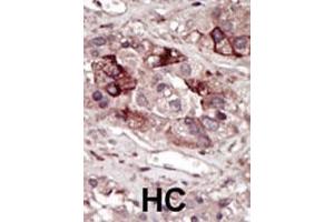 Formalin-fixed and paraffin-embedded human cancer tissue reacted with the primary antibody, which was peroxidase-conjugated to the secondary antibody, followed by DAB staining. (PHKG2 抗体  (AA 304-334))