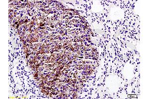 Formalin-fixed and paraffin embedded rat lung carcinoma labeled with Anti-Emp1/MUC1 Polyclonal Antibody (ABIN670086), Unconjugated at 1:200, followed by conjugation to the secondary antibody and DAB staining (EMP1 抗体  (AA 101-160))