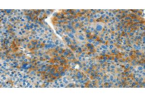 Immunohistochemistry of paraffin-embedded Human liver cancer tissue using L1CAM Polyclonal Antibody at dilution 1:40 (L1CAM 抗体)