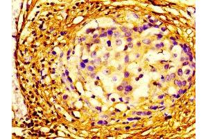 Immunohistochemistry of paraffin-embedded human breast cancer using ABIN7152106 at dilution of 1:100 (EIF4A2 抗体  (AA 1-407))