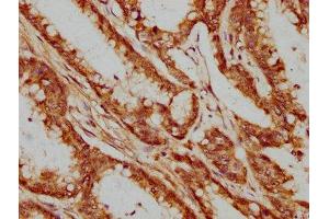 IHC image of ABIN7164186 diluted at 1:400 and staining in paraffin-embedded human colon cancer performed on a Leica BondTM system. (XAB2 抗体  (AA 750-840))