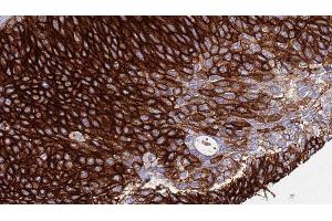 ABIN6276511 at 1/100 staining Human urothelial cancer tissue by IHC-P. (Nicastrin 抗体  (C-Term))
