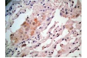 Human lung cancer tissue stained by Rabbit-Anti-GRP Pro (80-97) (H) Antibody (Gastrin-Releasing Peptide 抗体  (AA 80-97))