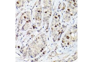 Immunohistochemistry of paraffin-embedded human breast cancer using RG Rabbit pAb (ABIN6127968, ABIN6146621, ABIN6220915 and ABIN6220916) at dilution of 1:50 (40x lens). (RACGAP1 抗体  (AA 353-632))
