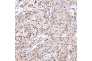 Immunohistochemical staining (Formalin-fixed paraffin-embedded sections) of human breast cancer with RBM3 monoclonal antibody, clone CL0296  shows moderate nuclear positivity in tumor cells. (RBM3 抗体)