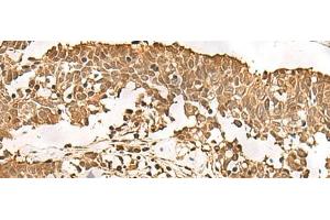 Immunohistochemistry of paraffin-embedded Human lung cancer tissue using PSMA3 Polyclonal Antibody at dilution of 1:50(x200) (PSMA3 抗体)