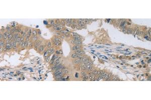 Immunohistochemistry of paraffin-embedded Human colon cancer tissue using P2RY11 Polyclonal Antibody at dilution of 1:30(x200) (P2RY11 抗体)