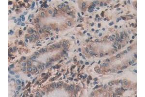 Detection of PDIA4 in Human Stomach cancer Tissue using Polyclonal Antibody to Protein Disulfide Isomerase A4 (PDIA4) (PDIA4 抗体  (AA 505-636))