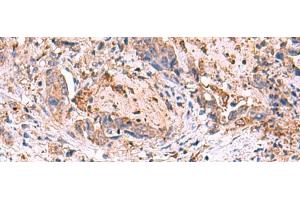 Immunohistochemistry of paraffin-embedded Human cervical cancer tissue using MPP1 Polyclonal Antibody at dilution of 1:50(x200) (MPP1 抗体)