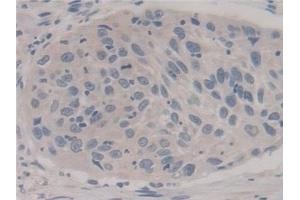 Detection of FIS1 in Human Lung cancer Tissue using Polyclonal Antibody to Fission 1 (FIS1) (Fission 1 抗体  (AA 1-117))