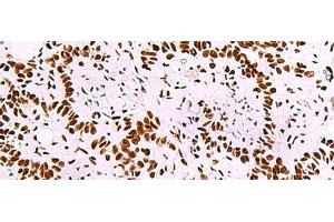 Immunohistochemistry of paraffin-embedded Human ovarian cancer tissue using TRIM28(phospho-Ser824) Polyclonal Antibody at dilution of 1:50(x200)